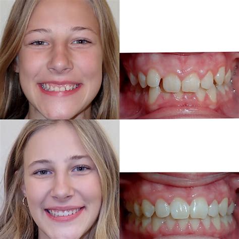 invisalign before and after underbite|invisalign before and after pictures.
